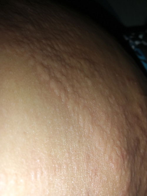 Pantal pantal sa katawan