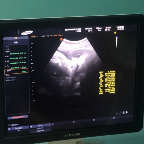 คลอดเอง&ผ่าคลอด