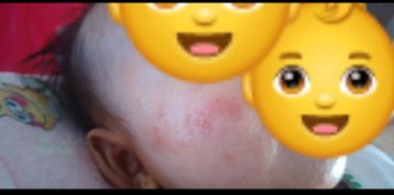 Bintik merah diwajah bayi