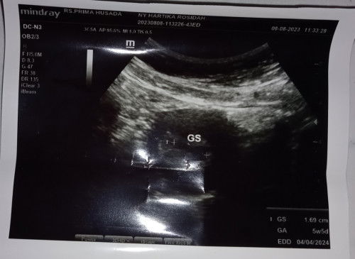 Hasil USG tapi masih gak tau cara bacanya.