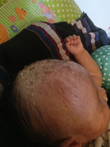 Hai moms,anak saya punya kerak kepala,sudah saya bersihkan tapi muncul lagi,muncul lagi,ada yg sama?