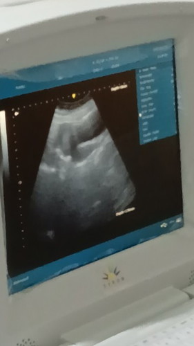 Bun mau tanya barusan usg, hpht 12 juli hasil pemeriksaan baru pembesaran rahim. Artinya apa ya bun?