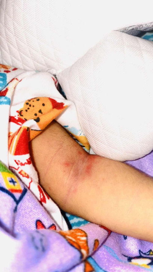 Ruam kemerahan dan bintik putih kecil