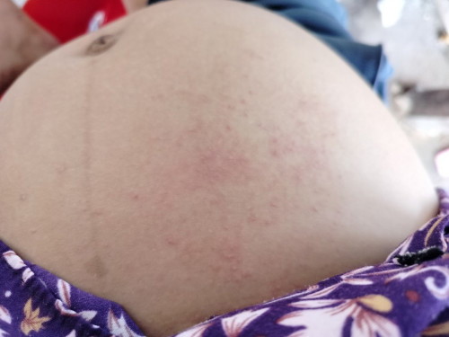 คุณแม่บ้านไหนผื่นขึ้นแบบนี้บ้างคะ 30 week