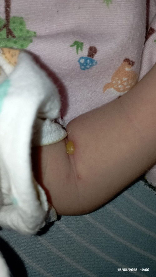 Benjolan bewarna kuning