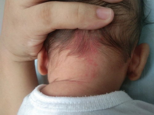 newborn rashes
