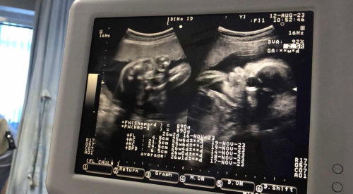 26สัปดาห์ เด็กๆในท้องแม่ๆแต่ละบ้านหนักเท่าไหร่กันบ้างคะ