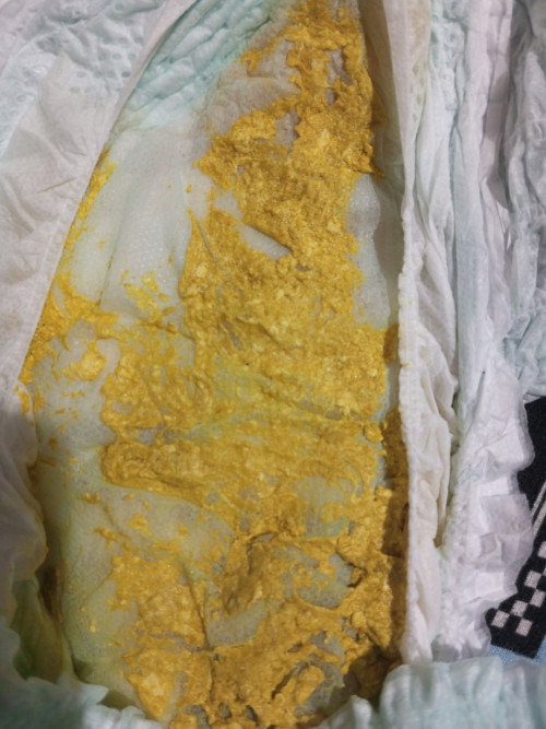 Is this poop normal? 10 months old baby