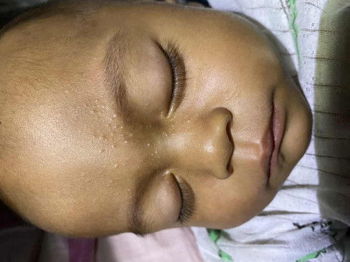 ตุ่มที่หน้า ใสๆ