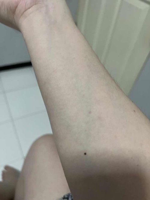 Stretchmark & gatal satu badan #TM3