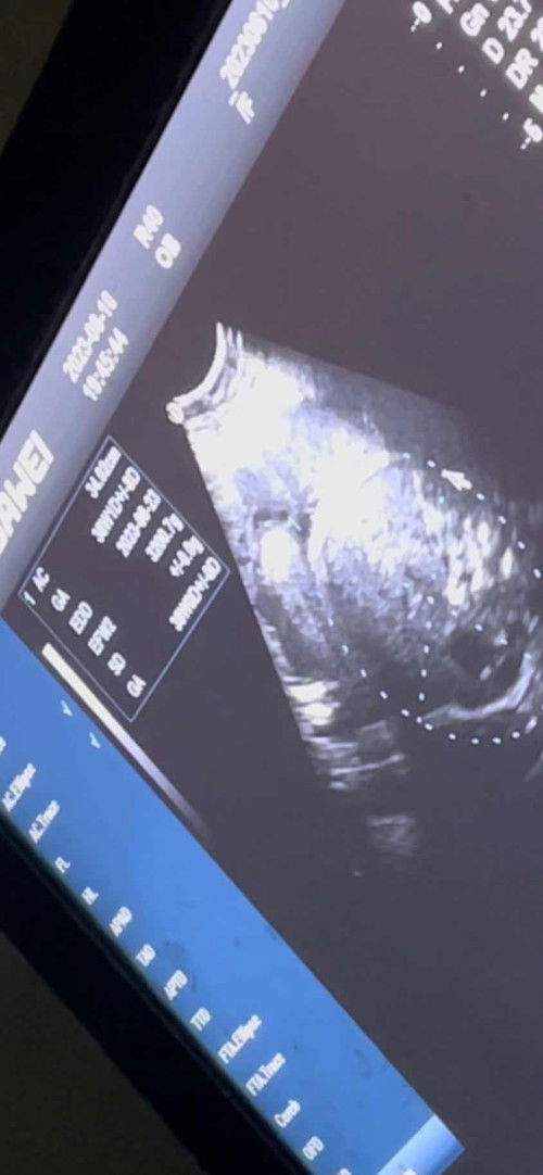 #สอบถามหน่อยค่ะ ท้องแข็งบ่อย ทั้งวันทั้งคืน อายุ 34 w