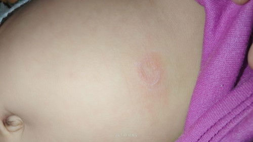 Perut bayi 3bulan merah seperti gatal