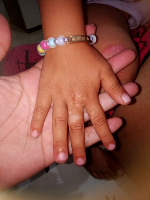 Tangan balita bercak putih (fitiligo)