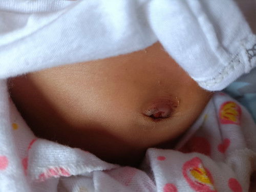 สะดือลูกหลุดแต่มีเลือดซึมๆ