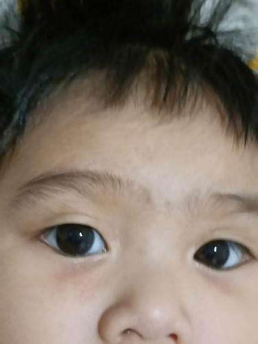 ลูก6เดือนมีผื่นแบบนี้ขึ้นที่หน้า
