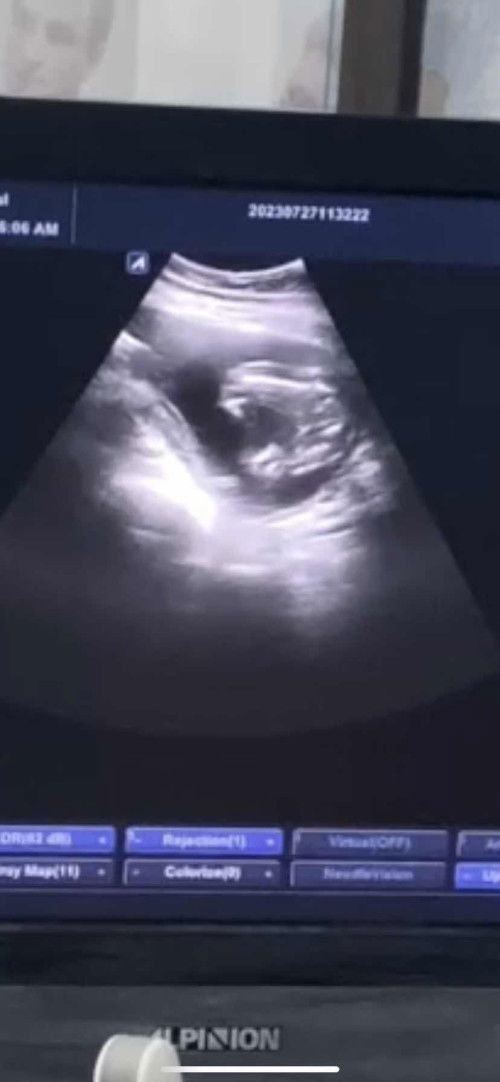 รบกวนแม่ๆดูให้หน่อยได้ไหมคะ ว่าน้องเป็นผู้หญิงหรือผู้ชาย หมอบอกผู้หญิงประมาณ 70% ค่ะ