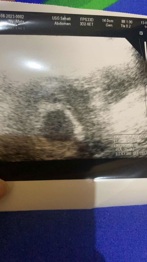 Normal ga bun masih kantung kehamilan ?