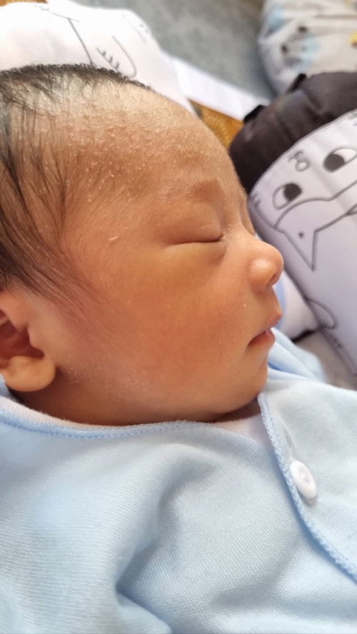 Bruntusan dikulit bayi