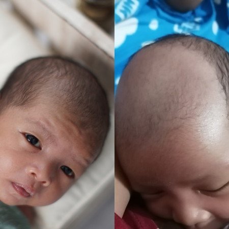 Nakakalbo ang buhok ni baby