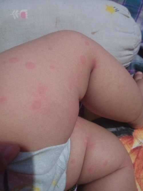 Ini ruam2 kira2 kenapa ya Bun,ada yg tau ga?