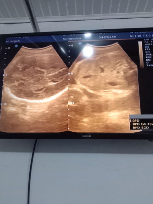 Bunda saya diagnosa plasenta Previa pasial ( plasenta rendah)