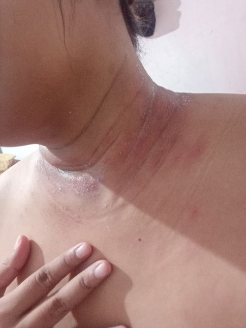 makin hari makin parah gatelny tp dokter blng wajar...
obat alami ny apa yah ?? ada yg sama gak?