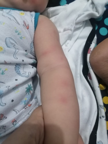 Nag karon po ng rashes ang baby ko sa s26 gold.