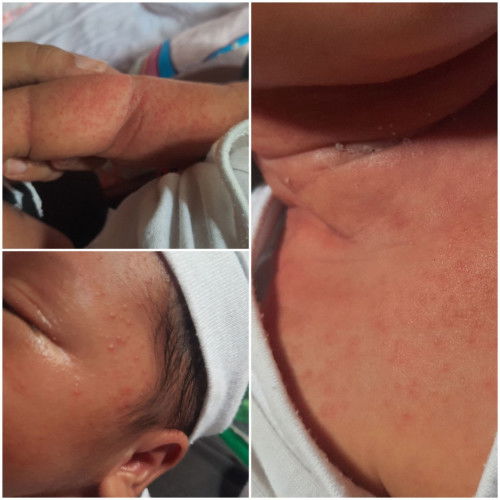 Baby Acne ba ito mommies?