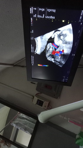 Cord coil @ 5 months (21 weeks)