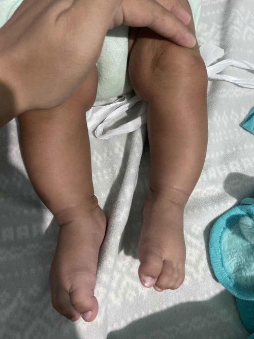 Kaki si kecil tidak lurus
