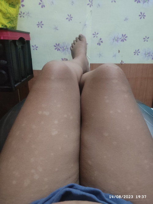 Skin allergy simula ng nagbuntis