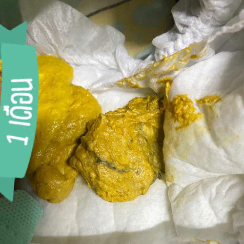 อุจจาระทารกกก