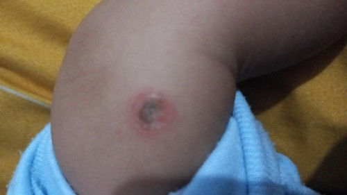 Bintik merah kaya kesundut rokok