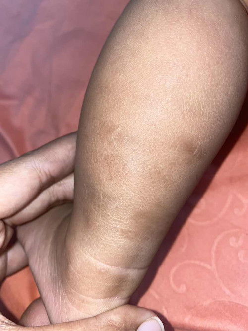 Kulit bayi mengering