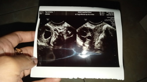 Ada yg tau ga baca hasil USG transvaginal ini kira² gmna kt dokternya normal doang pdhl pngn dijlsin