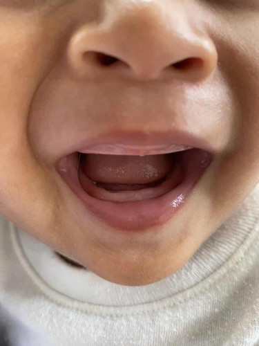 แบบนี้แปลว่าฟันขึ้นมั้ยคะ