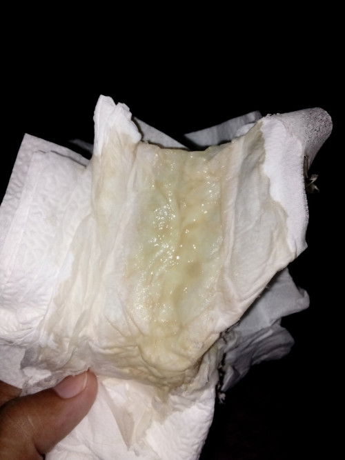 ขอสอบถามหน่อยค่ะ เราคลอดน้องก่อนกำหนดตอนอายุครรภ์ได้30+2คลอดน้องมาได้23วันน้ำคาวปลามีสีแบบนี้ปกติไม่