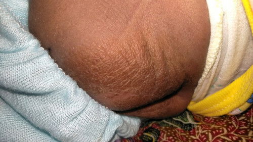 Pantat bayi seperti terkelupas