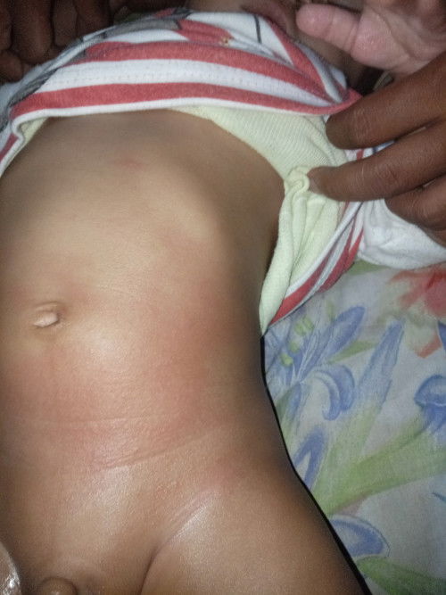 Kemerahan pada perut bayi