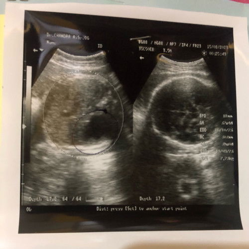 Dokter yg USG saya mendiagnosa janin saya Atresia Duodenum