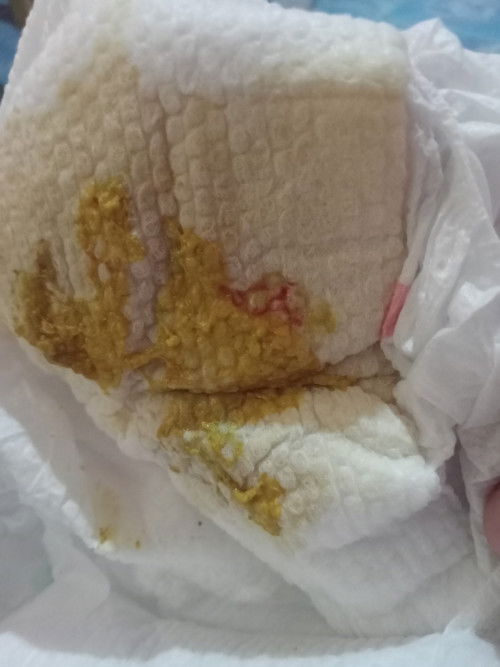 May kunting dugo yung poop ng baby ko nestogen po yung gatas nya