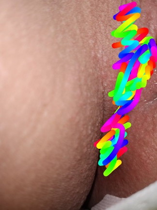 มีอาการคันเป็นตุ่มๆตั้งแต่ตรงข้างๆช่องคลอดลามไปถึงก้น