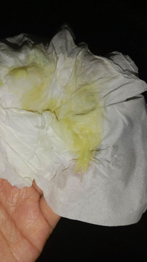 Keputihan berwarna kuning kehijauan