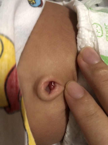 ตอสะดือไม่หลุด อันตรายไหม