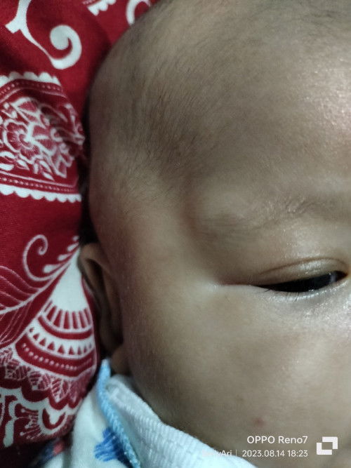 Benjolan pada alis bayi usia 2 bln