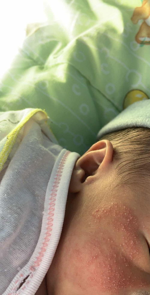 Bintik banyak di pipi