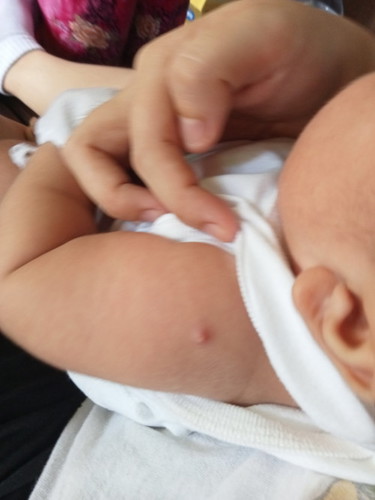 Something sa braso ng baby. 3 months old