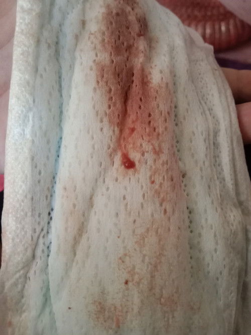 ท้อง39w ตรวจภายใน แล้วมีมูกเลือด อันตรายไหมคะ