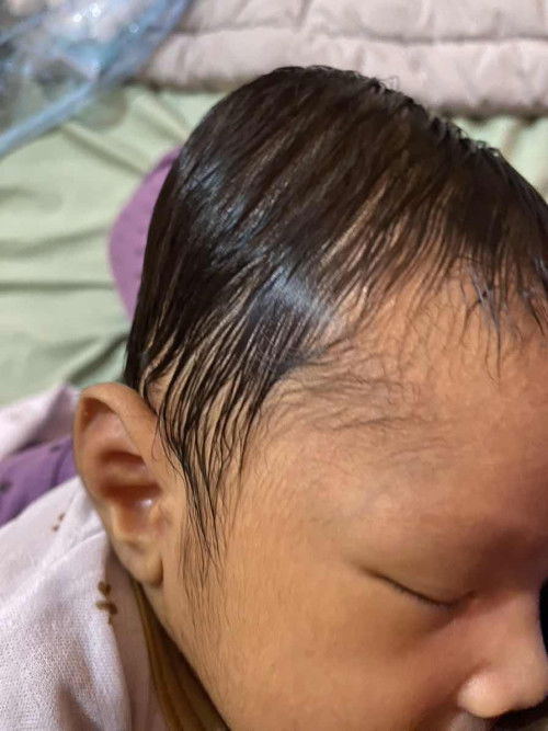 Benjolan di kepala bayi