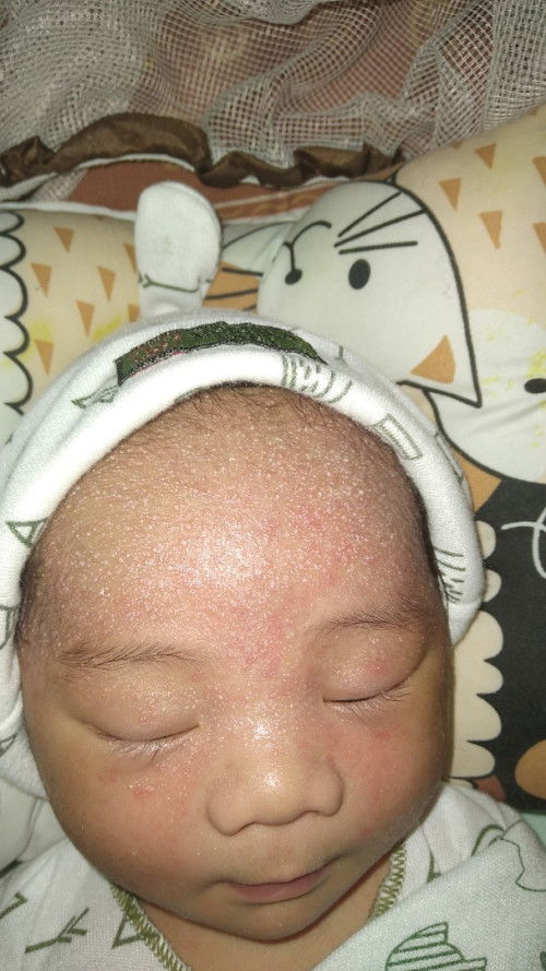 Buun anak aku usia 1 minggu,mukanya beruntusan seperti ada airnya,kira² penyebab/obatnya apa ya bun?